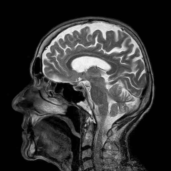 Тошнота и нарушение речи могут указывать на опухоль мозга